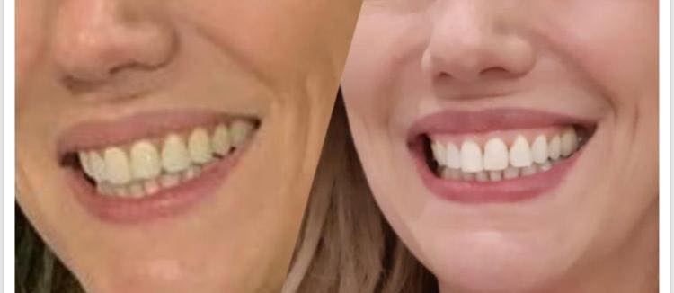 Fiz 50… E agora quero fazer um clareamento dental. Fiz 50… E agora quero fazer um clareamento dental.